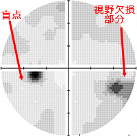 初期緑内障の視野